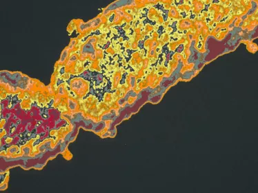 Fiches maladies - Coqueluche - Institut Pasteur
