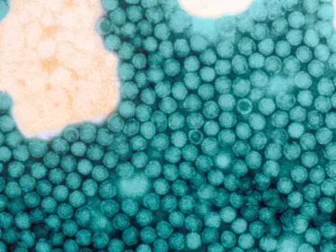 Fiches maladies - Poliomyélite - Institut Pasteur