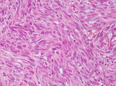 Fiches maladies - Sarcome de Kaposi - Institut Pasteur