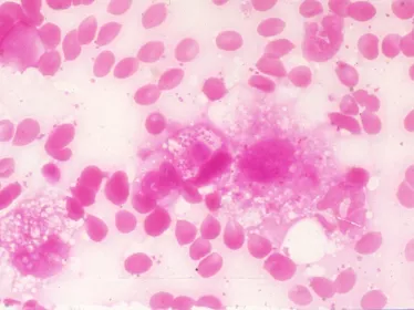 meningite - Institut Pasteur