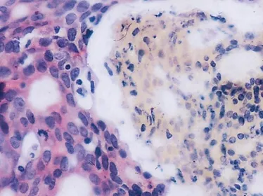 Fighting cancer - Institut Pasteur