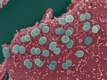 actéries Neisseria meningitidis adhérant à la surface de cellules épithéliales. Les diplocoques sont enchevêtrés dans des microvillosités d'origine cellulaires. 
