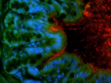Un déséquilibre du microbiote intestinal favorise la survenue d’un cancer colorectal 
