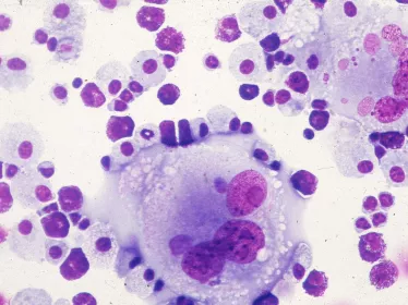 Allogreffe de cellules souches hématopoïétiques : des travaux mettent en évidence les modifications majeures du métabolome humain au cours de la réaction du greffon contre l’hôte 