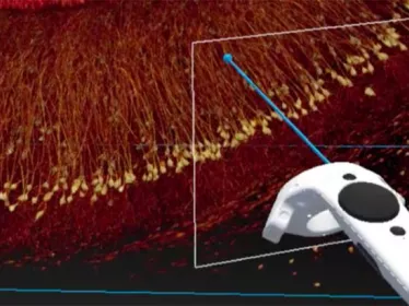 Brain connectivity and neurodegenerative diseases