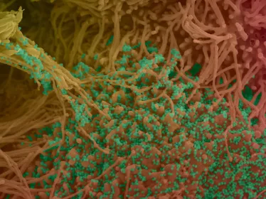 Cellules bronchiques humaines infectées par SARS-CoV-2