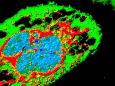 Cellule infectée par Zika (effet cytopathique), présentant de larges vacuoles (trous). En rouge : protéine virale. En vert : cellule. En bleu : noyau. Microscopie par immunofluorescence. 