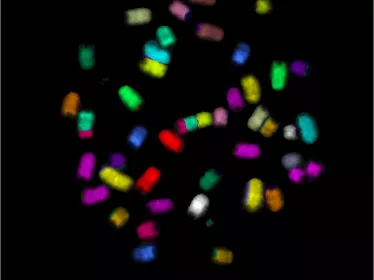 Chromosomes métaphasiques d’une cellule lymphoïde cancéreuse 