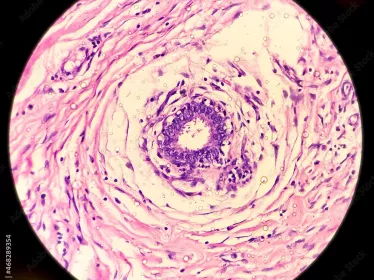 hidradenitis suppurativa © AdobeStock
