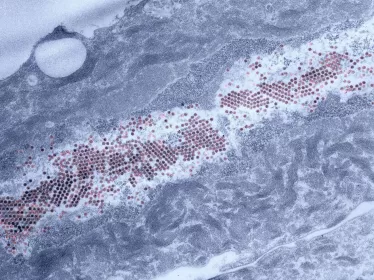 human_papillomavirus_particles_in_a_genital_lesion_superficial_cell