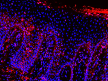 Immunoglobluline A (IgA) dans une peau d’un malade Verneuil en stade sévère