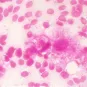 meningite - Institut Pasteur
