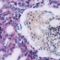 Fighting cancer - Institut Pasteur