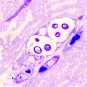 Méningoencéphalite cryptococcique - Institut Pasteur