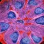 Malaria:parasite resistance to artemisinin derivatives now affecting Africa