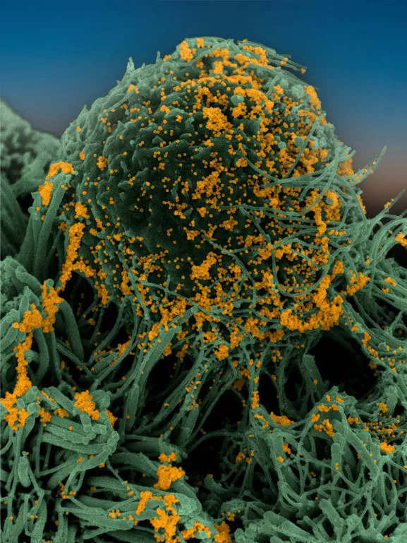 Cellules bronchiques humaines (en vert) infectées par SARS-CoV-2 (orange). Image obtenue par microscopie électronique à balayage puis colorisée.